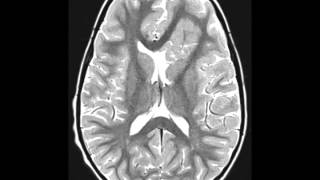 Cortical Dysplasia [upl. by Janicki394]