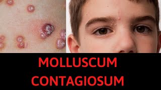 What is Molluscum Contagiosum Symptoms Treatment [upl. by Acirtap]