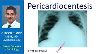 Pericardiocentesis [upl. by Ahsinar]