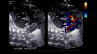 PATENT DUCTUS ARTERIOSUS LEFT HEART DILATION [upl. by Ja]