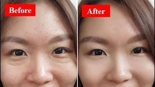 How To Get Rid Of Your Eye Bags Fast amp Naturally At Home [upl. by Meehyr]