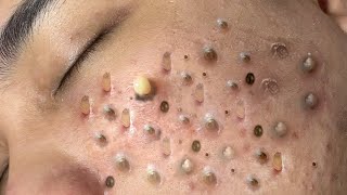 ACNE TREATMENT VU QUYNH MI Blackheads Removal Popping [upl. by Quinton675]