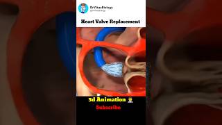 Heart Valve Replacement Procedure 👨‍⚕️ [upl. by Charmian]