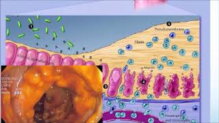 عدوى الكلوستريديوم العسير  Clostridioides difficile infection [upl. by Elehcar62]