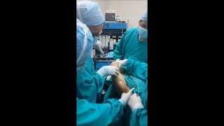 Liposuccion asistida por laser laser lipolisis Brazos El Salvador [upl. by Menendez]