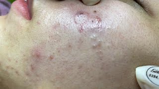 Acne treatment for Spa Linh Mun 2023 027 [upl. by Ahtar]