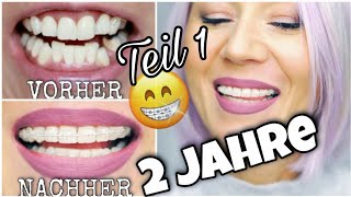 2 JAHRE FESTE ZAHNSPANGE  UPDATE😮 QampA Zahnspange Erwachsene Keramik Brackets WithKat [upl. by Naima]