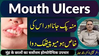 Mouth Ulcers منہ پک جانا मुँह के छाले Homeopathic Treatment in Urdu  Hindi [upl. by Garreth850]