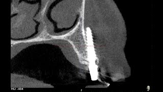 IMPORTANCE OF HAVING COMMON SENSE AND IN HOUSE CBCT IN IMPLANTOLOGY  discussion by drcmurugavel [upl. by Kaitlynn210]