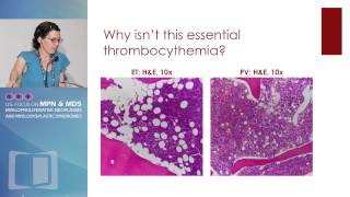 “Masked” Polycythemia vera and Polycythemia vera “in Evolution” [upl. by Ramat]