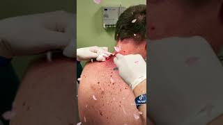 Las Vegas Dermatology Cyst Follow up video 🎥 with incision and drainage procedure 💉 🔪 [upl. by Haya571]