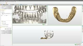 Match the intraoral scan to the CBCT scan step4 [upl. by Hguh104]