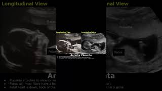 Anterior Placenta Position Ultrasound  Fetal USG  Pregnancy Sonography  Dr Sams Imaging shorts [upl. by Leotie]