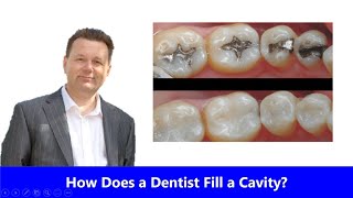 How Does a Dentist Fill a Cavity [upl. by Annorah]