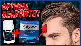 Combining Finasteride amp Minoxidil [upl. by Reniar]