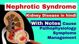 Nephrotic syndrome  causepathologysymptoms  kidney disease  medical surgical nursing lecture [upl. by Sedruol491]