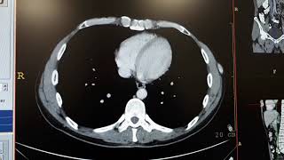 Hemangioma in liver ct [upl. by Ollehcram]