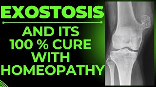 EXOSTOSIS  BONY EXOSTOSIS  BEST HOMEOPATHIC MEDICINE FOR EXOSTOSIS [upl. by Ayrolg]