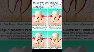 STAGES OF GUM DISEASES dental dentist dentistrystudent chatgpt [upl. by Ahsikad]