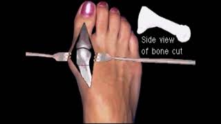 Austin bunionectomy with Akin osteotomy Moderate bunion correction surgery [upl. by Navaj]