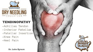 Tendinitis and Tendinopathy Dry Needling Treatment Protocol [upl. by Capwell506]