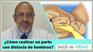 Cómo realizar un parto con distocia de hombros [upl. by Baillie]