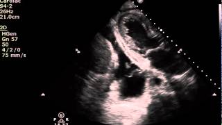 Cardiac Tamponade  pericardial effusion causes pathophysiology investigations and treatment [upl. by Aoht580]