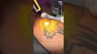 Tattoo Removal TATTOOIMPEC Mysore [upl. by Esiouqrut424]