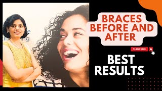 How to Fix Crooked Teeth in AdultBraces JourneyBraces Before AndAfterBracesonteeth Braces Pune [upl. by Elata512]