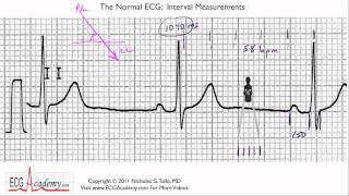 Interval Measurements 64  ECG  EKG Interpretation  BASIC [upl. by Draude754]