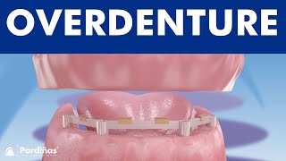 Overdenture with dental implants © [upl. by Gnauq]