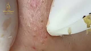 Loan Nguyen Acne Treatment 0288hn [upl. by Adroj]