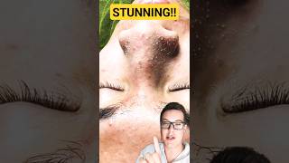 ULTIMATE PORE STRIP REMOVAL  How To Prep Skin For Pore Strips shorts [upl. by Dranek]