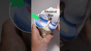 Meniscal tear knee model [upl. by Dnalel]