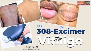 308Excimer For Vitiligo  Excimer Laser Treatment For Vitiligo by DrKailash  Clear Skin Kurnool [upl. by Gilleod]