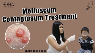 How to treat Molluscum Contagiosum  Treatment of viral skin infection  Dr Priyanka Reddy [upl. by Moshell]