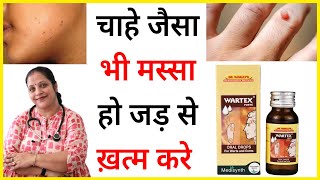 मस्से का इलाज  Warts homeopathic medicine  Warts ka ilaj  Masse ka ilaj [upl. by Reisman899]