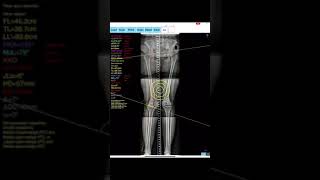 Osteotomy App [upl. by Lexis]