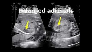 Congenital adrenal hyperplasia [upl. by Nolubez853]