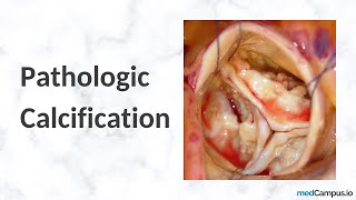 Metastatic vs Dystrophic Calcification  Pathology  High YIeld [upl. by Schertz]