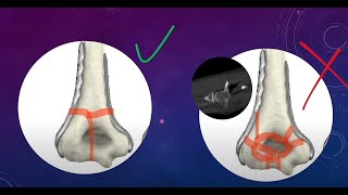 Complex Distal Intercondylar humerus Fractures Part I surgical planning [upl. by Ailisab]