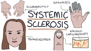 Systemic Sclerosis and Scleroderma Visual Explanation for Students [upl. by Inesita]