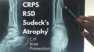 CRPSRSDSudecks AtrophyAlgodystrophy  CF amp Xray findings amp prevention  Dr Abdullah Al Rafi [upl. by Ahsii]