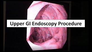 Upper GI Endoscopy Procedure in the ED [upl. by Delastre]