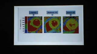 Lecture 9 Valvular heart diseases [upl. by Mylan897]