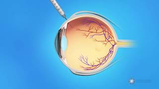 Eye Injections for Branch Retinal Vein Occlusion BRVO [upl. by Freya]