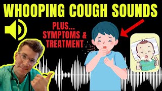 Doctor explains WHOOPING COUGH plus examples of REAL SOUNDS  Symptoms diagnosis treatment amp more [upl. by Ytsur]