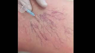 Ozone Therapy to treat Varicose Veins [upl. by Eixel284]