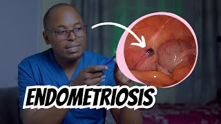 Endometriosis Explained Symptoms Causes and Treatment Options [upl. by Angrist]