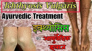 Ichthyosis Vulgaris Ayurvedic Treatment  Fish Scale Disease  Dr Mohammad Azam  इक्थ्योसिस [upl. by Belter312]